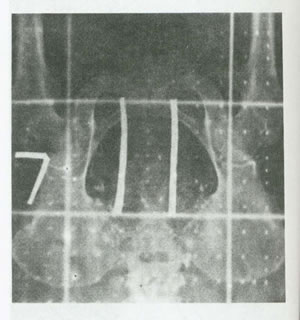 موارد مصرف پرتو درماني در طب زنان